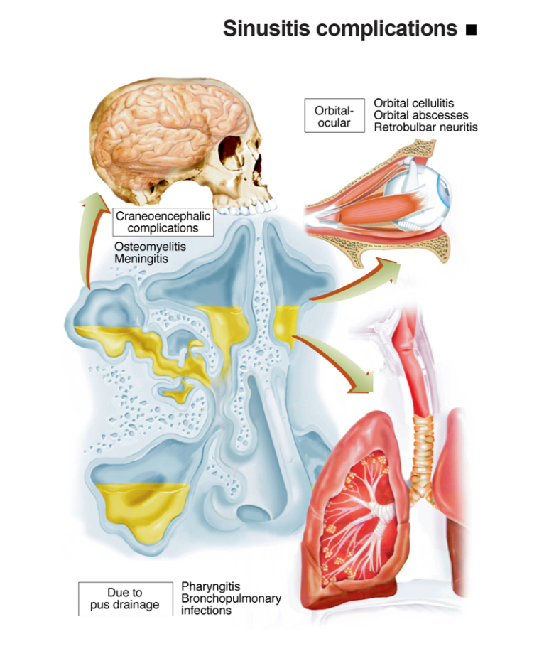 Infografis komplikasi sinusitis
